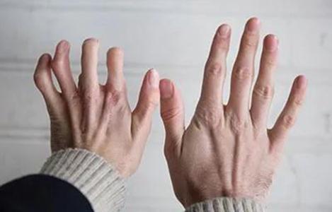 手指康复训练视频大全,全方位指导,轻松恢复手部功能