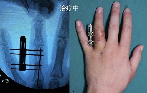 手指康复训练视频大全,全方位指导,轻松恢复手部功能